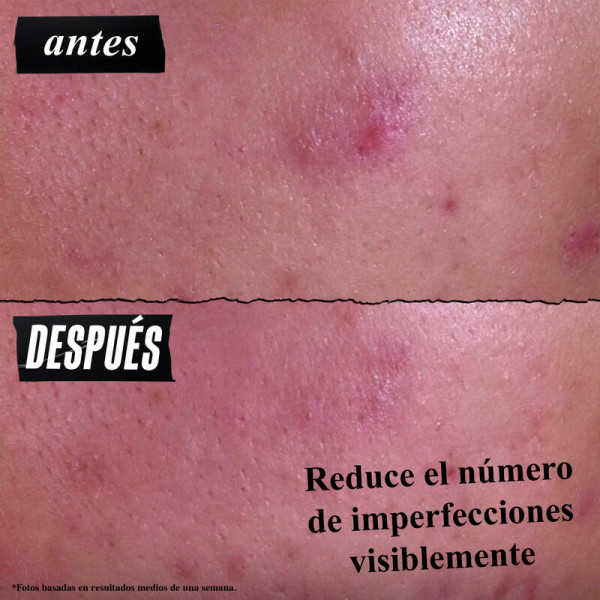 gently-effective-blemish-targeting-tratamiento-limpiador-acne