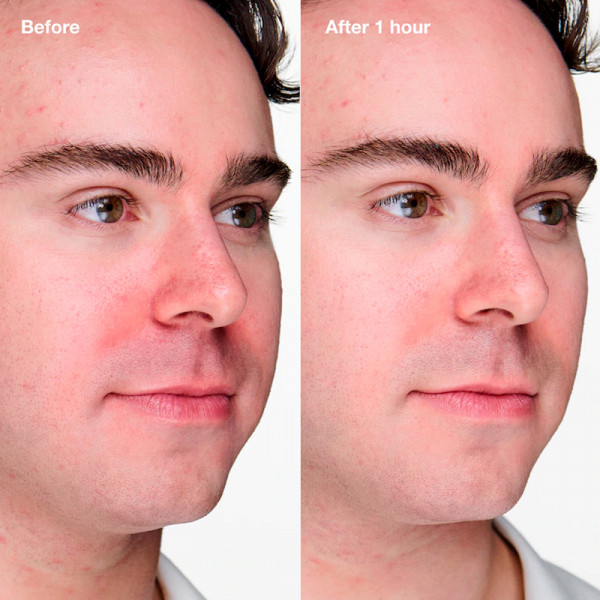 anti-blemish-solutions-clinical-fortschrittliches-anti-pickel-gel