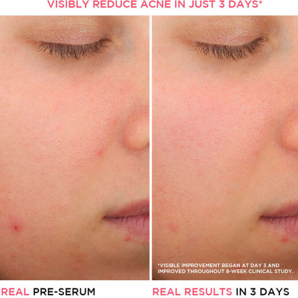 bye-bye-breakout-salicylic-acid-serum